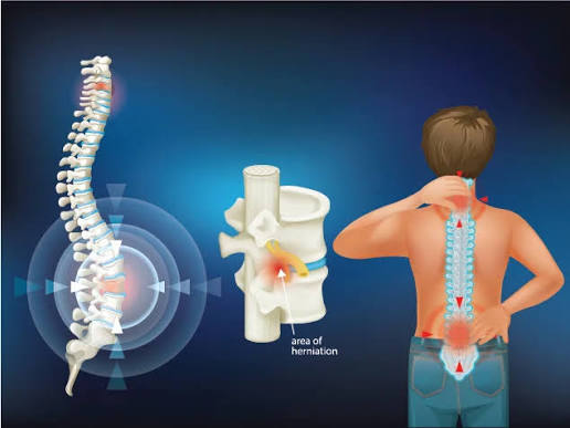Pain and Suffering Damages for Spinal Cord Injuries